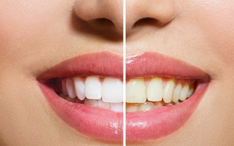Get More Benefits By Professional Teeth Whitening Treatment at Affordable Rates