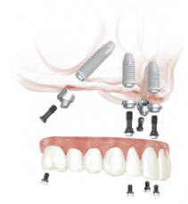How Much Are Dental Implants Cost