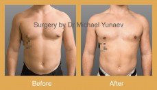  Professional Male Breast Reduction Surgery in Sydney - Contact Us Now!