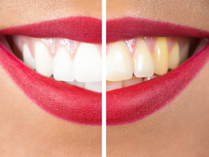 Best Teeth Whitening Dentist In NSW | Rejuvenate Your Smile 