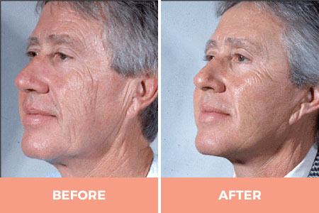 High-Quality Lower Face Lift Surgery in Sydney -  Contact Dr Hodgkinson Today!